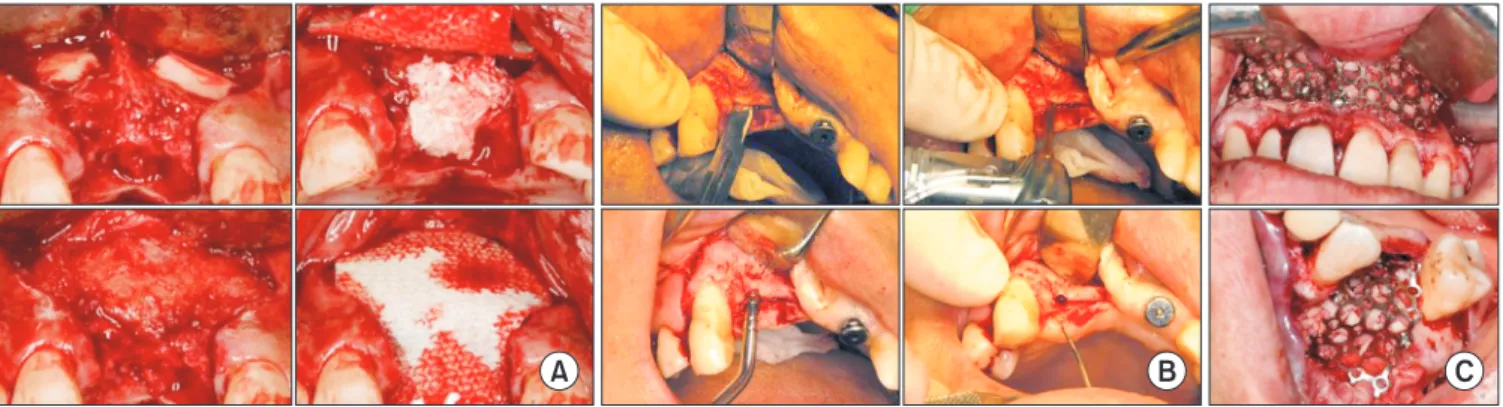 Fig. 4. Various techniques for horizontal ridge augmentation. A. Maxillary anterior horizontal ridge augmentation called ‘sandwich bone  augmentation.’ Two autogenous bone blocks were grafted on the labial aspect, freeze dried allogenic bone was grafted ab