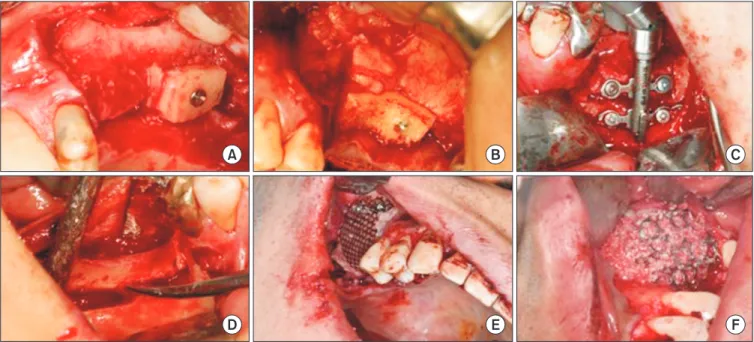 Fig. 5. Various techniques for vertical ridge augmentation. A. An autogenous bone block was grafted on the alveolar crest and fixed with  titanium screws