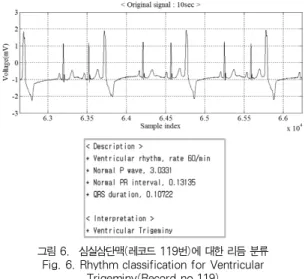 Fig. 6. Rhythm classification for Ventricular Trigeminy(Record no.119) 그림 7은 제안된 알고리즘을 이용하여 자극전도장애로 발 생하는 부정맥에 대한 분류 결과를 예시한 것이다