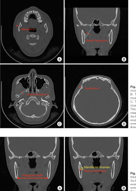 Fig. 1. A. Thickness of the masseter  muscle (m.) measured in axial view. 