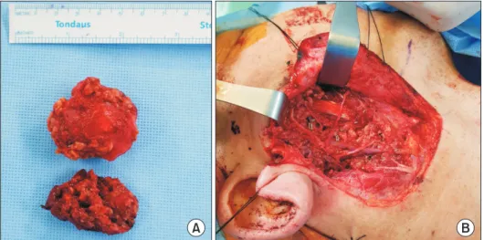 Fig. 3. A. Low-power view revealed well  circumscribed high-grade carcinoma  showing variable sized cysts and  irregu-lar ductal structures with marked  necro-sis (H&amp;E staining, ×20)