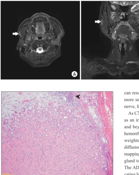 Fig. 4. Small portion of the tumor showed hyalinized area sugges- sugges-tive of pre-existing pleomorphic adenoma (arrowhead) (H&amp;E  stain-ing, ×100).