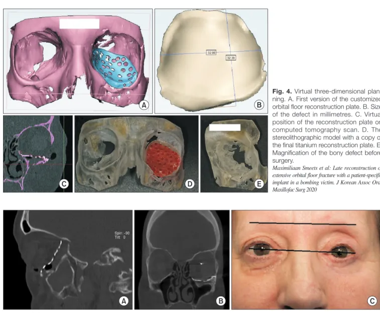 Fig. 4. Virtual three-dimensional plan- plan-ning. A. First version of the customized  orbital floor reconstruction plate