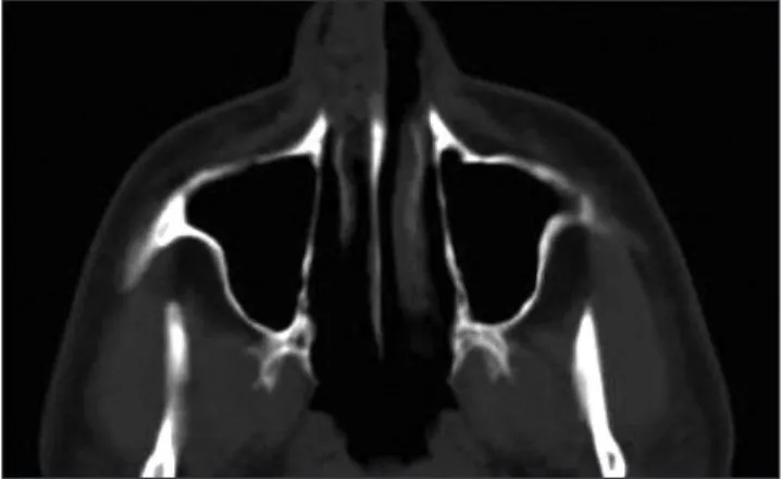 Fig. 1. Computed tomography scan of the nasal angiofibroma.