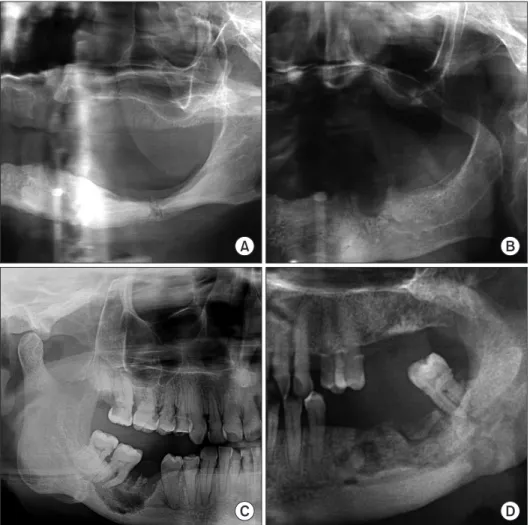 Fig. 2. Radiological findings of some  medication-related osteonecrosis of the  jaw (MRONJ) patients in this study
