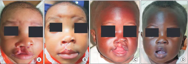 Fig. 1. A 4-month-old female with right unilateral cleft lip and alveolus, preoperative picture (A) and postoperative picture (B) showing a  repair with the Millard technique that the guardian judged to be satisfactory