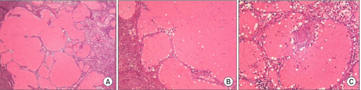 Fig. 6. Histologic section (H&amp;E staining). A. Papillary endothelial cell proliferation in the dilated vascular lumen (×40)