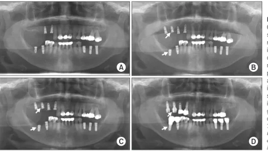 Fig. 5. Panoramic radiogram of a  67-year-old female who had  hyperten-sion and osteomyelitis in the posterior  right mandible
