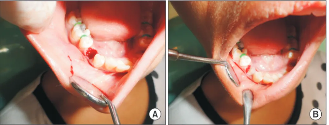 Fig. 3. A. Extraction socket. B. Extrac- Extrac-tion socket with plasma-rich growth  factors.