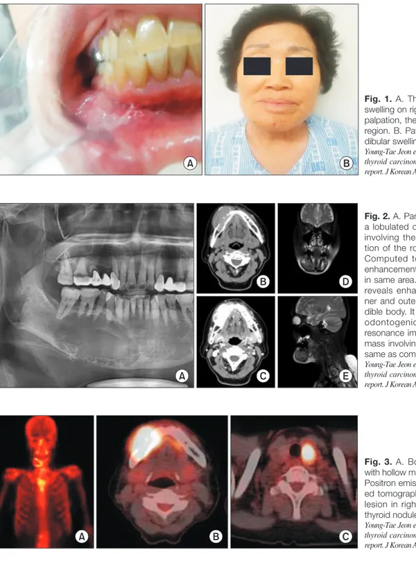 Fig. 1. A. The picture shows gingival  swelling on right mandible body area. In  palpation, there is hardness on swelling  region