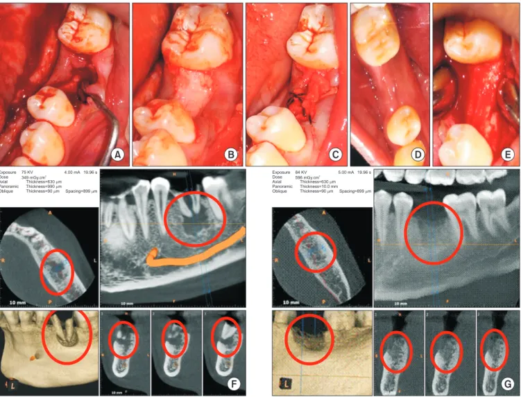 Fig. 1. A. Bone defect immediately after extraction with curette in place. B. Bone graft material placed till crestal level in the mandibular left  first molar socket