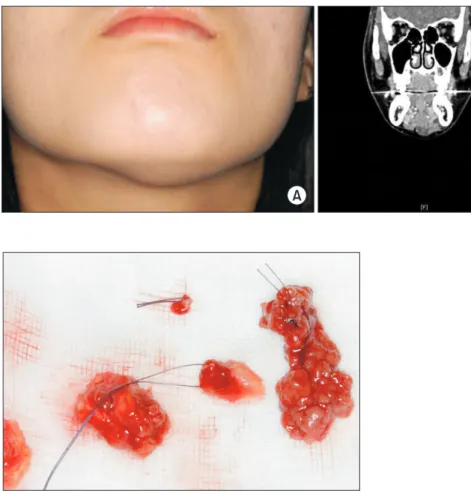 Fig. 1. A. The patient showed left sub- sub-mental swelling. B. On computed  to-mography, a mutilocuated cystic lesion  at the left sublingual and submental  space was observed