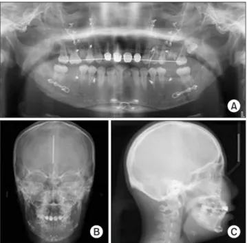 Fig. 2. Images produced three weeks after surgery in the study  patient. A. Computed tomography with contrast