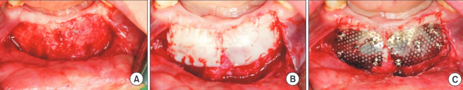 Fig. 3. Titanium mesh removal at four weeks after surgery. A. Excessive soft tissue growth covering the mesh