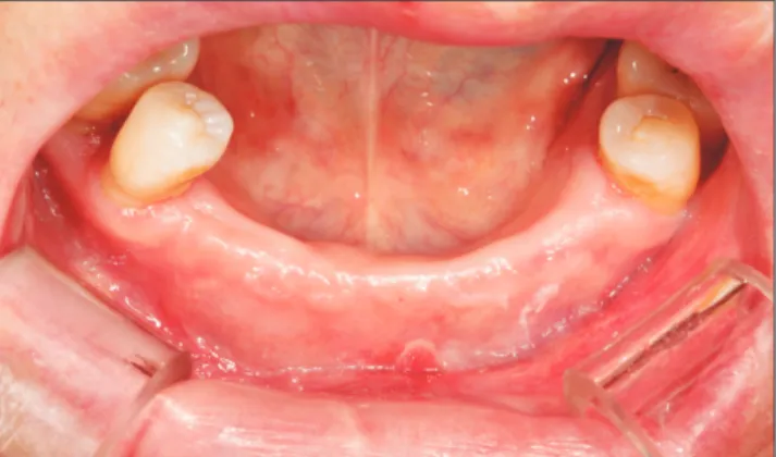 Fig. 4. Eight weeks after the operation (four weeks after mesh  removal). Sufficient amounts of keratinized gingiva and vestibular  depth were obtained.