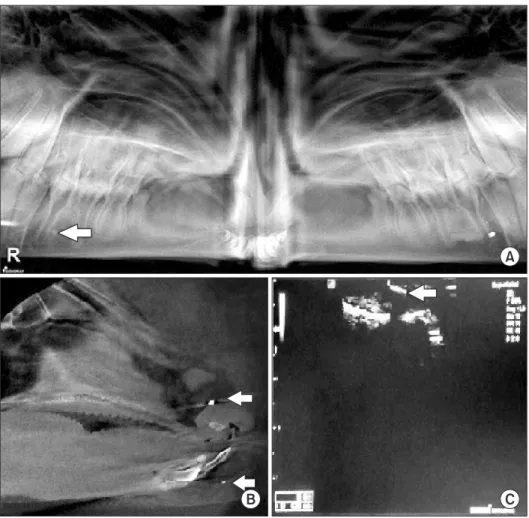 Fig. 2. A. Panoramic radiography view  of 2 mm metal (left) and 2 mm stone  (right) on bone surface