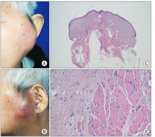 Fig. 1. A. Front view of the patient  showing an erythematous,  protrud-ing mass on the left side of the face