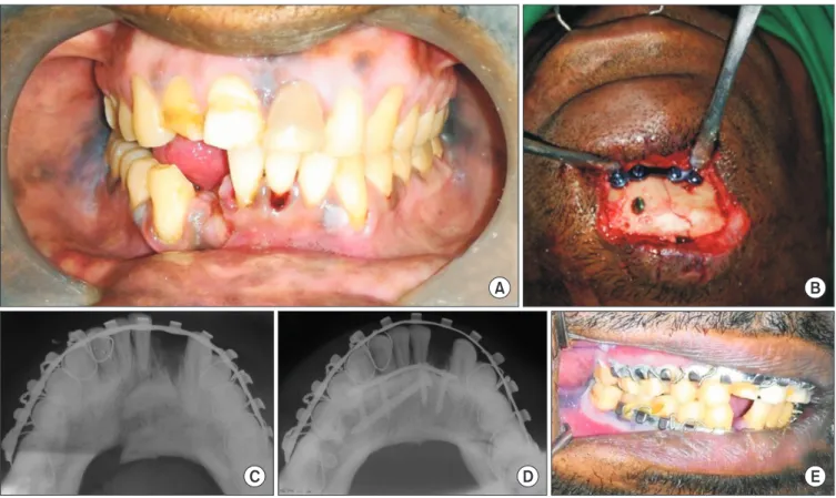 Fig. 2. Displaced right parasymphysis fracture managed through extraoral approach under regional anesthesia with lag screw and 4-hole  titanium miniplate