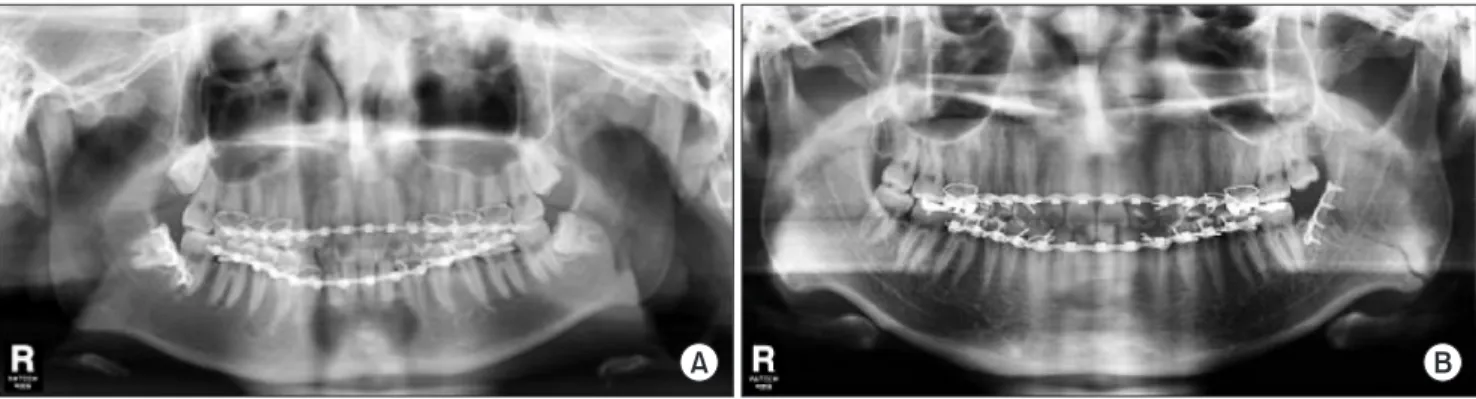 Fig. 1. Postoperative panoramic radiographs. A. Non-extraction case. B. Extraction case.