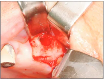 Fig. 5. Idiopathic bone cavity in the left maxilla.