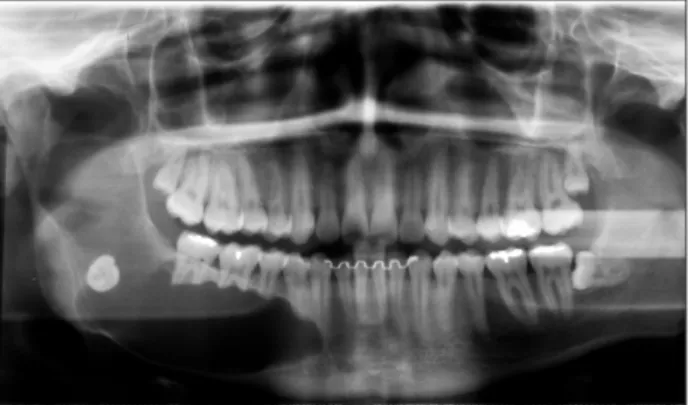 Fig. 3. Axial and coronal computed tomography scans highlighting lesion expansion. Note the lingual and buccal cortical plate expansion  and thinning.