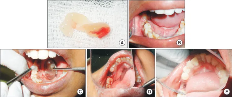 Table 1. Criteria for diagnosis of dry socket (tick appropriate)
