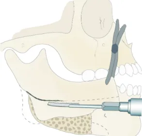 Fig. 2. Diagram of ostectomy design under the mental foramen  after fixation of proximal segment to distal segment of mandible.