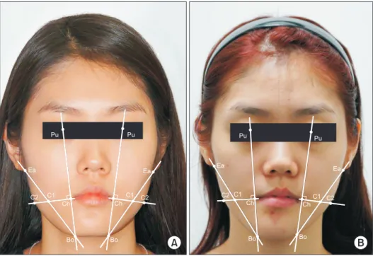 Fig. 3. Liner measurements and reference landmarks used in  this study. (Pu: midpoint of pupil, Ch: most lateral point between  upper and lower lip, C1: intersection of a line drawn from Ch  per-pendicular to Po-Bo and a line between Ba-Bo, C2: intersectio