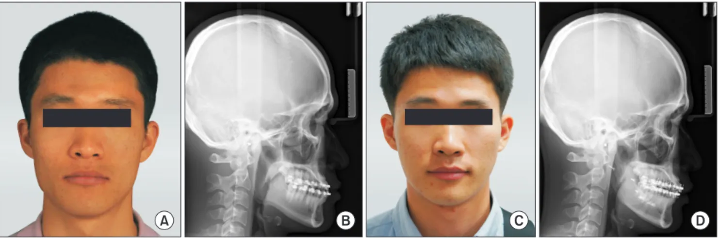 Fig. 5. Preoperative (A, B) and postoperative (C, D) changes of a frontal facial photograph and cephalometric lateral radiograph in Group A
