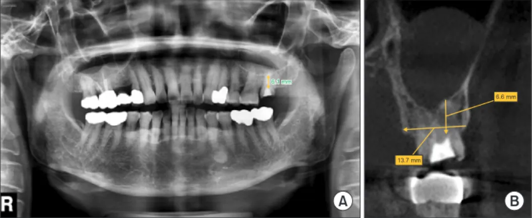 Fig. 1. Removed #27 gold crown. The  maxillary sinus was pneumatized. Bone  height of 6.1 mm (panorama, A), 6.6  mm (cone-beam computed  tomogra-phy, B) was measured
