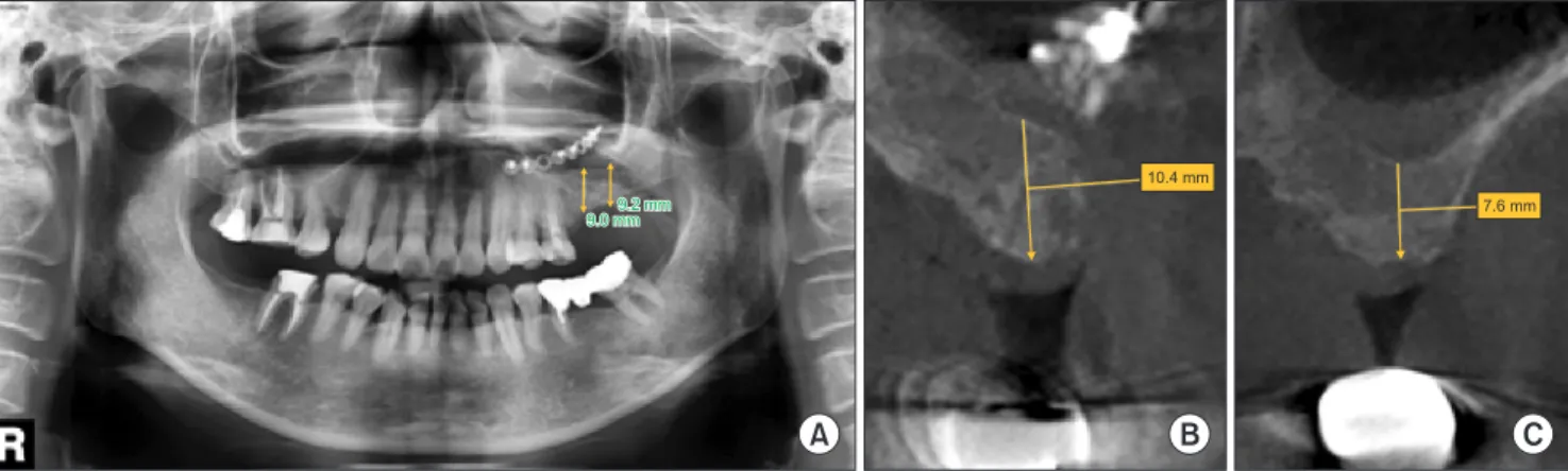 Fig. 6. Eight months postoperatively: extraction socket was filled with new bone, and bone levels were elevated to 9.0 mm (panorama, A),  10.4 mm (cone-beam computed tomography [CBCT], B) (#26) and 9.2 mm (panorama, A), 7.6 mm (CBCT, C) (#27)