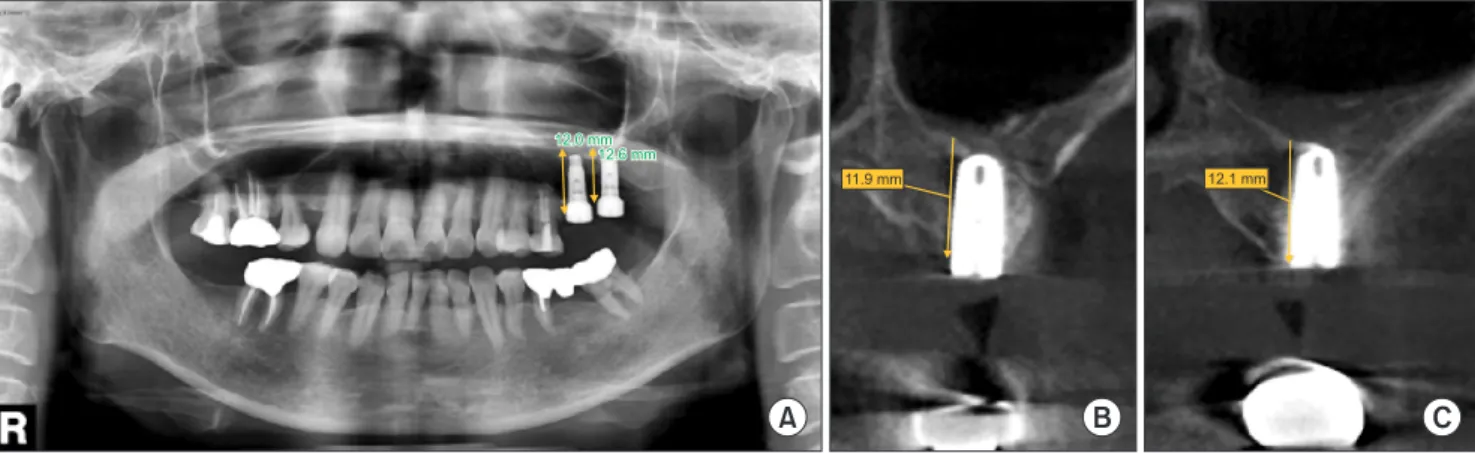 Fig. 7. Seven months post-implantation: ridge bone heights of 12.0 mm (panorama, A), 11.9 mm (cone-beam computed tomography  [CBCT], B) (#26) and 12.6 mm (panorama, A), 12.1 mm (CBCT, C) (#27) were achieved