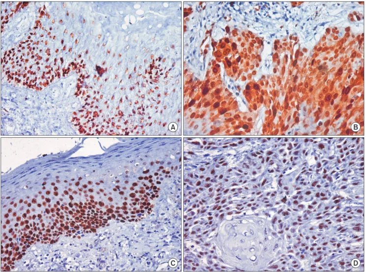 Fig. 1. A. Cyclin D1 expression in leukoplakia (×400). B. Cyclin D1 expression in oral squamous cell carcinoma (×400)