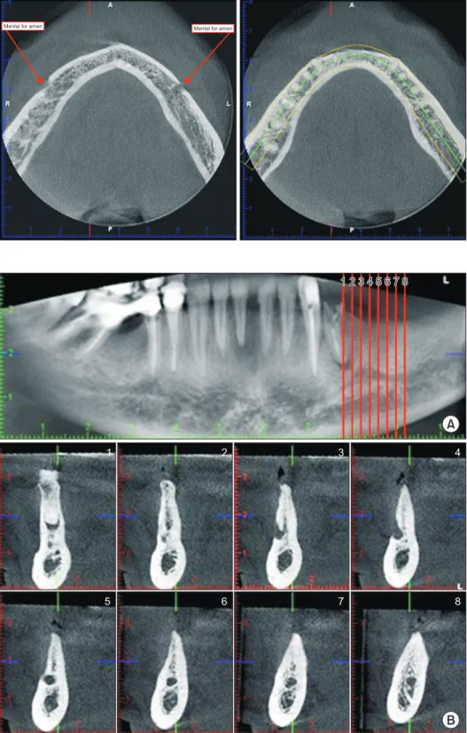 Fig. 1. Both left and right mental fo- fo-ramina on the axial section and  pan-oramic curve drawn on the axial  sec-tion.