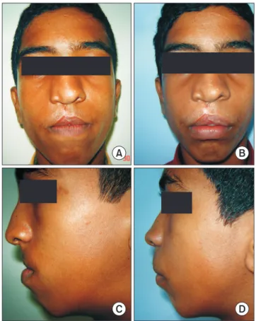Fig. 4. Clinical photographs of the initial anterior maxillary distrac- distrac-tion procedure (at 12 years)