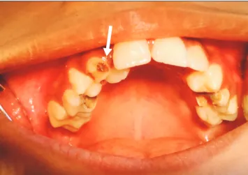 Fig. 3. Panoramic radiograph showing bilateral maxillary and  mandibular impacted permanent canines (arrows).