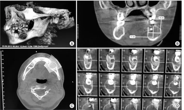 Fig. 3. A. Cone-beam computed tomography image of the lesion shows a well-defined lesion in the mandibular left region surronding the  crown of the unerupted second premolar