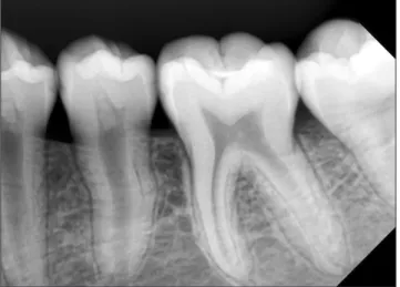 Fig. 5. Periapical radiograph of the second premolar at postop- postop-erative 46 months