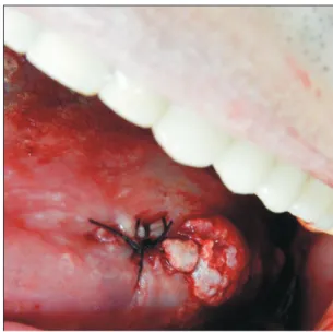 Fig. 6. Scaphoid-shaped surgical site immediately after biopsy.