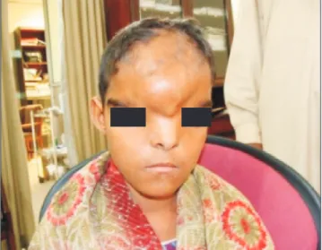 Fig. 2. Preoperative three-dimensional  reconstruction of the same patient  showing frontal bone defect and grade  III hypertelorism.