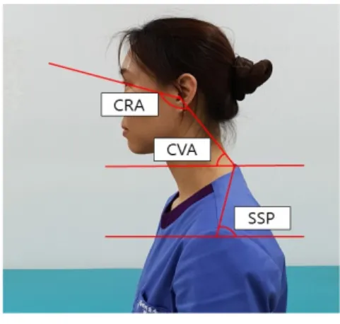 Figure  2.  Posture feature.CRA를 측정하였으며(Chae, 2002), C7의 SP와 견봉후각을 연결한 선과 수평선이 만나 이루는 SSP를 측정하였다(Ha 등, 2016)(Figure 2)