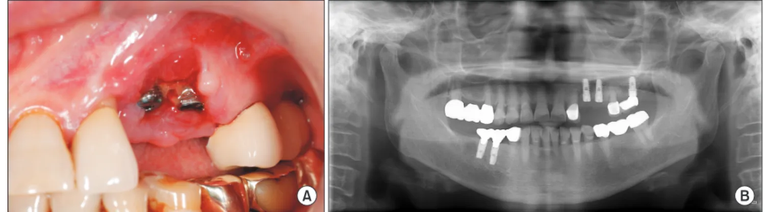Fig. 4. Intraoral photograph of the necrotic bone exposure in the  upper left molar area.