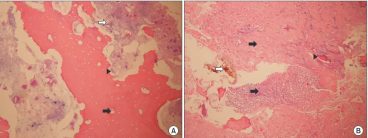 Fig. 4. A. Features about necrotic bone from biopsy specimen. The presence of cell components and blood vessels cannot be found and  the formation of the new bones around the osteocystic lacunae are destroyed (black arrow)