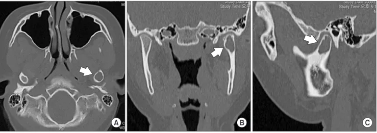 Fig. 2. Preoperative computed tomography. Trabecular pattern is not detected in the bone marrow space of the left condyle head (arrows)  on axial (A), coronal (B), or sagittal view (C).