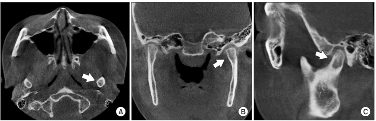 Fig. 7. Postoperative 43 months cone-beam computed tomography images. Normalized bony cavity without defect (arrows) on axial (A),  coronal (B), and sagittal (C) views.