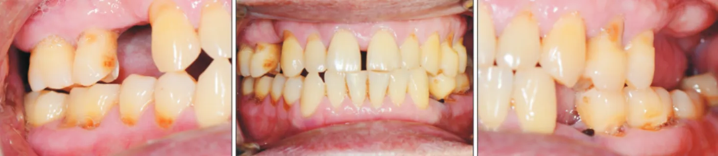Fig. 4. Occlusion discrepancy of the right side was improved but open bite of right molars was remained at 7 days after treatment.