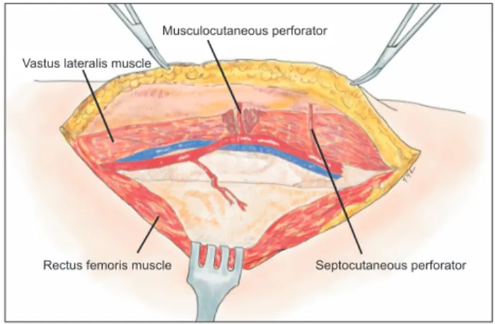 Fig. 2. The course of vascular pedicles  was categorized into three types. In  type I (A), the main pedicle derives from  the descending branch of the lateral  circumflex femoral artery (LCFA)