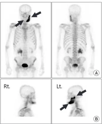 Fig. 4. Sclerotic change with mild fluorodeoxyglucose (FDG)  uptake in left mandible. Ten-month follow-up positron emission  tomography-computed tomography