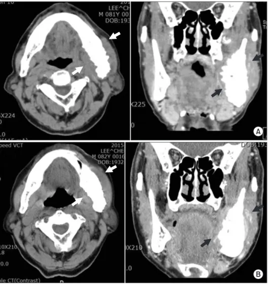 Fig. 5. Follow-up computed tomog- tomog-raphy (CT). A. Mandible CT axial and  coronal view (5 months)