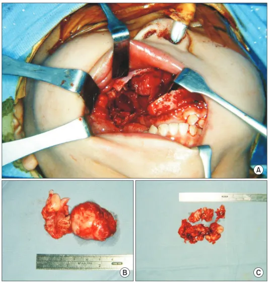 Fig. 3. Intraoperative photograph. A. 